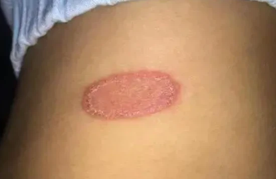 What to do if a person gets ringworm in a cat?